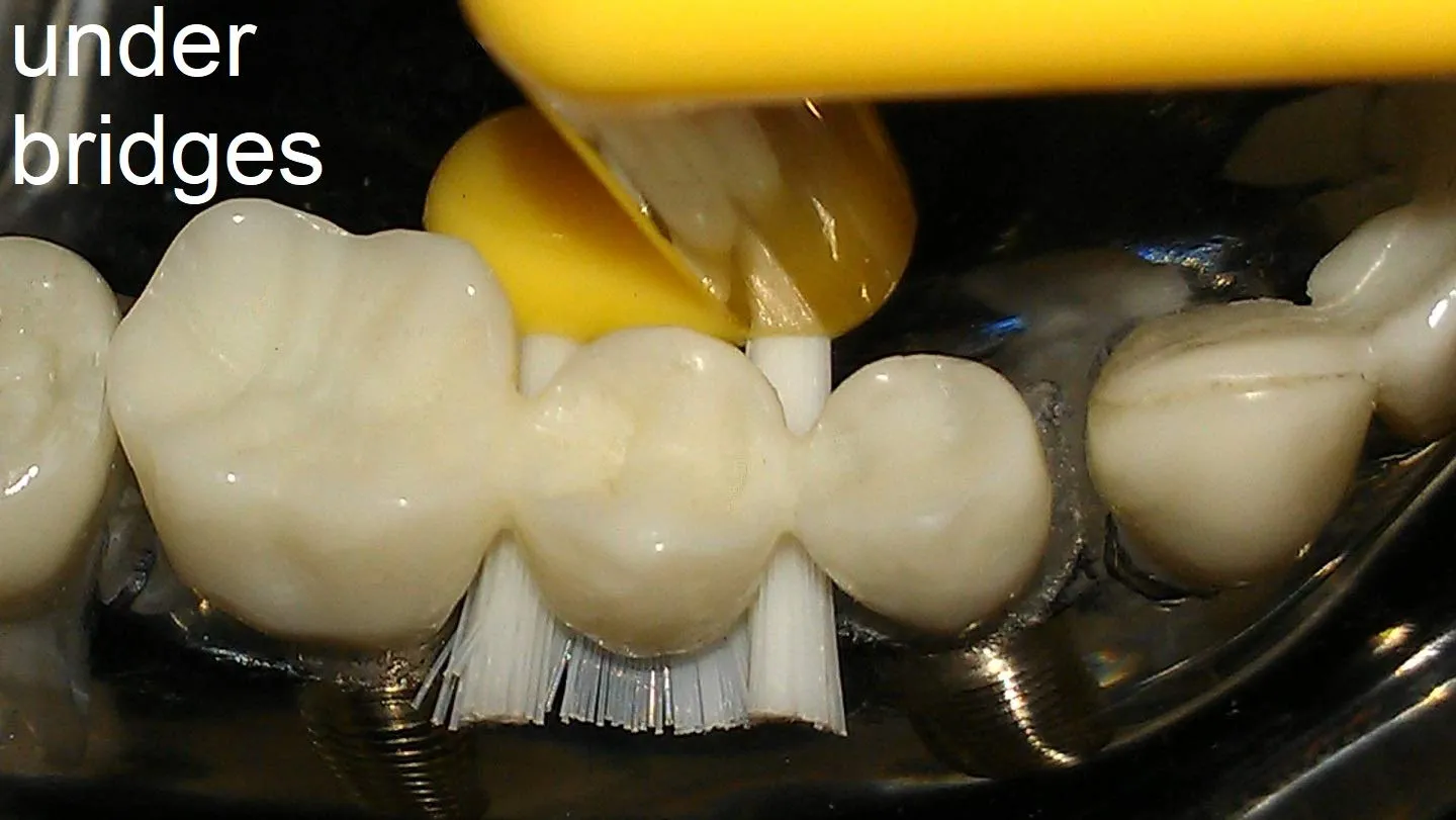 ImplantClean Dental Implant Toothbrush - for implants, bridges, fixed dentures, and gums - SOFT Bristles