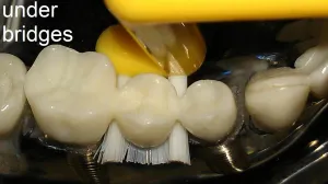 ImplantClean Dental Implant Toothbrush - for implants, bridges, fixed dentures, and gums - SOFT Bristles